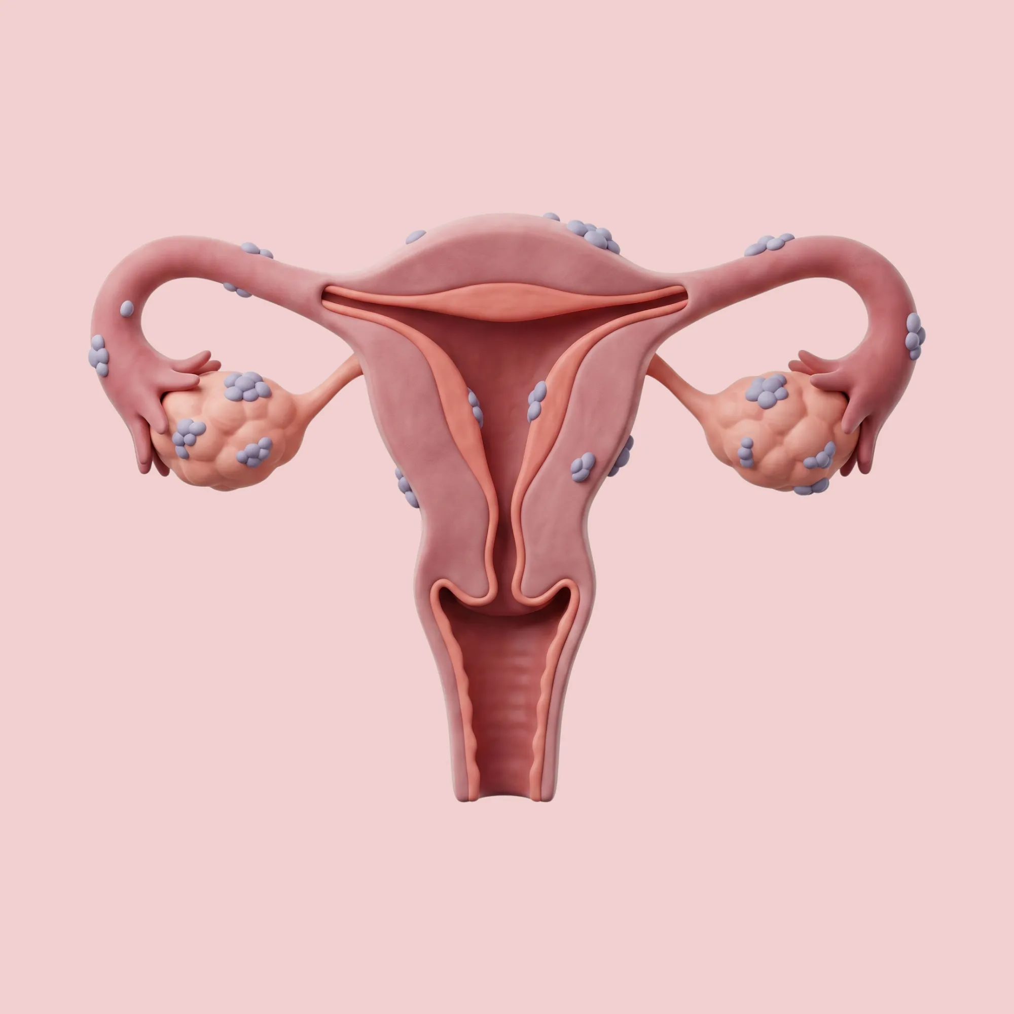 Endometriosis & adenomyosis