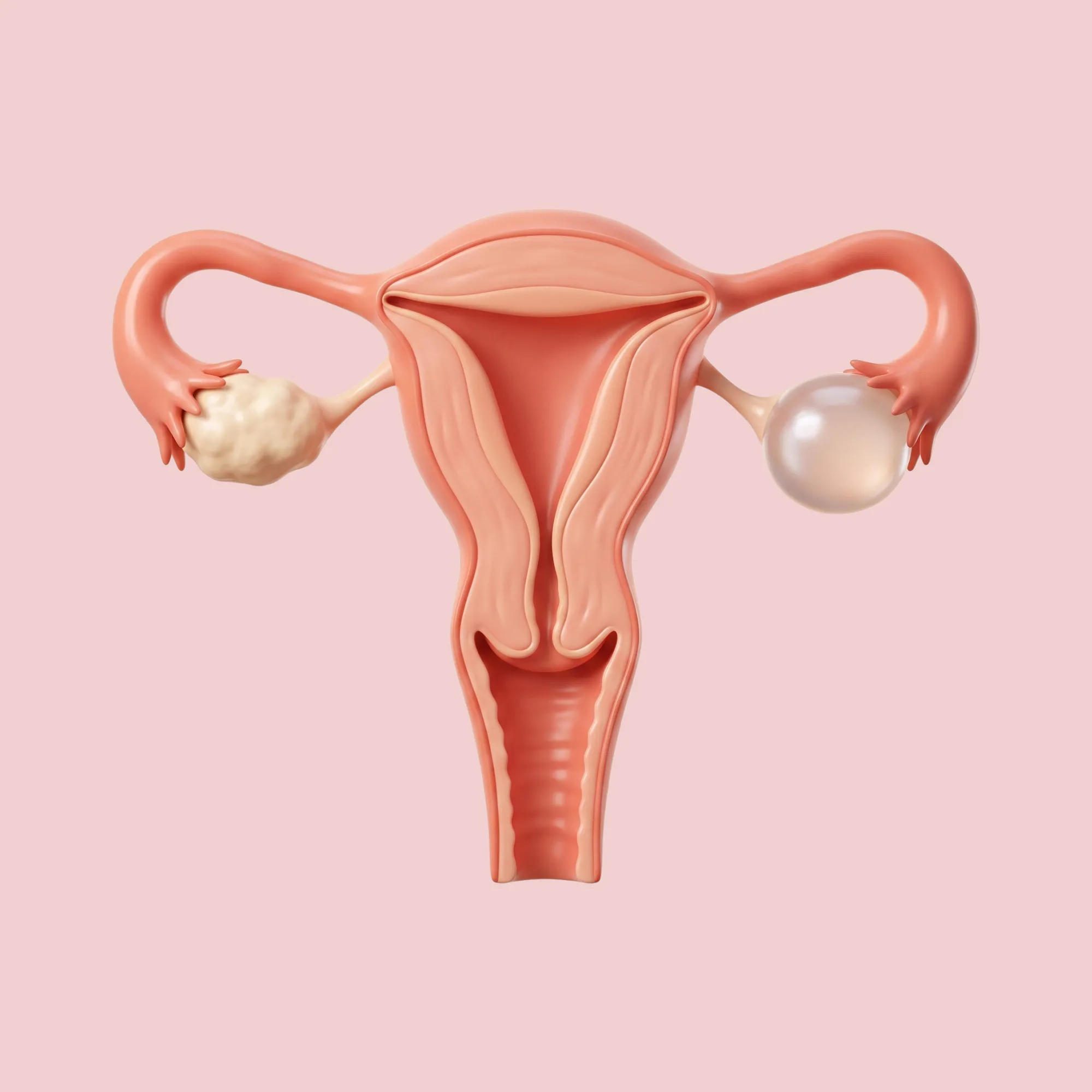 Ovarian cysts