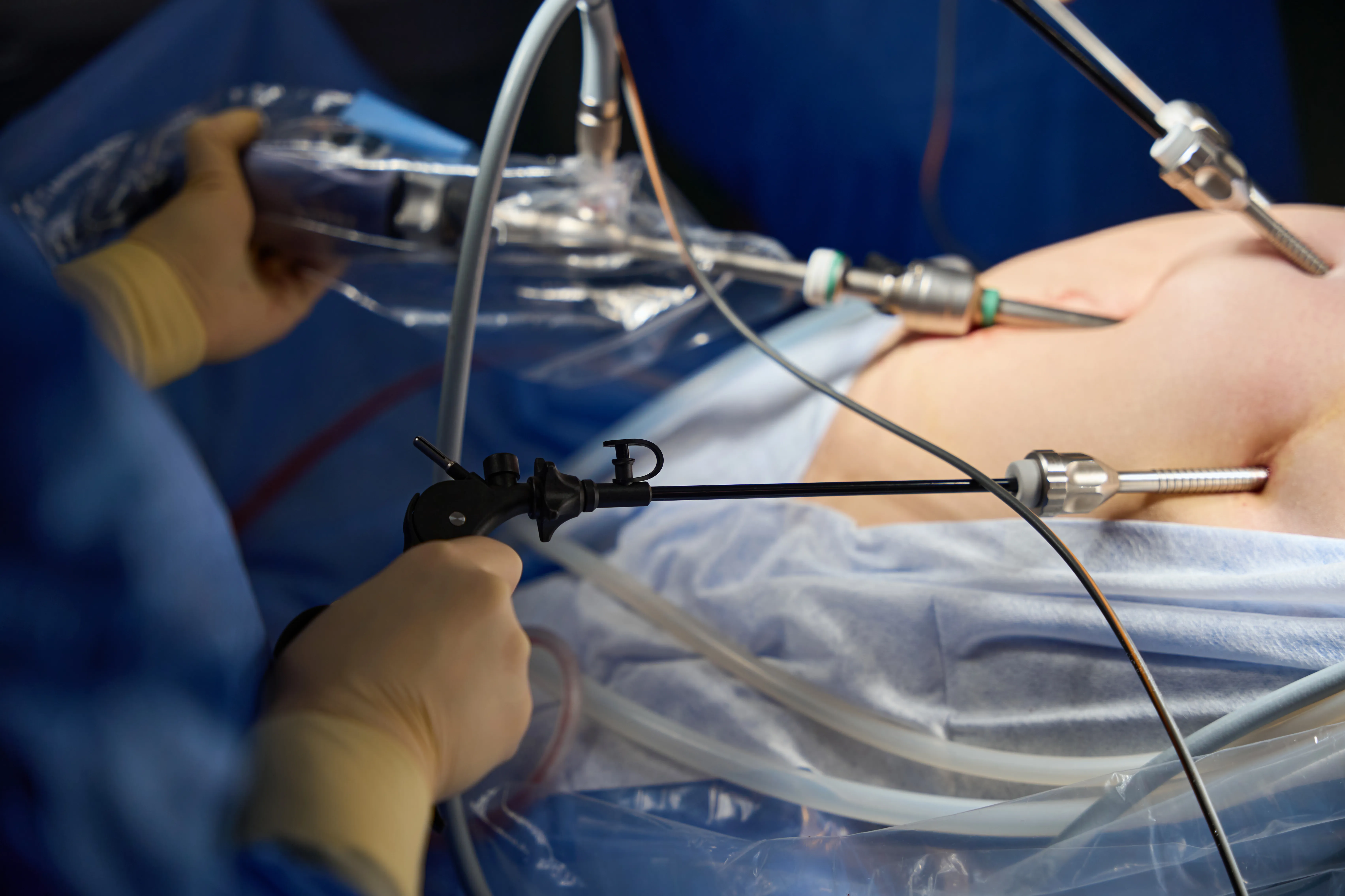 Total Laparoscopic Hysterectomy (TLH ± BSO)